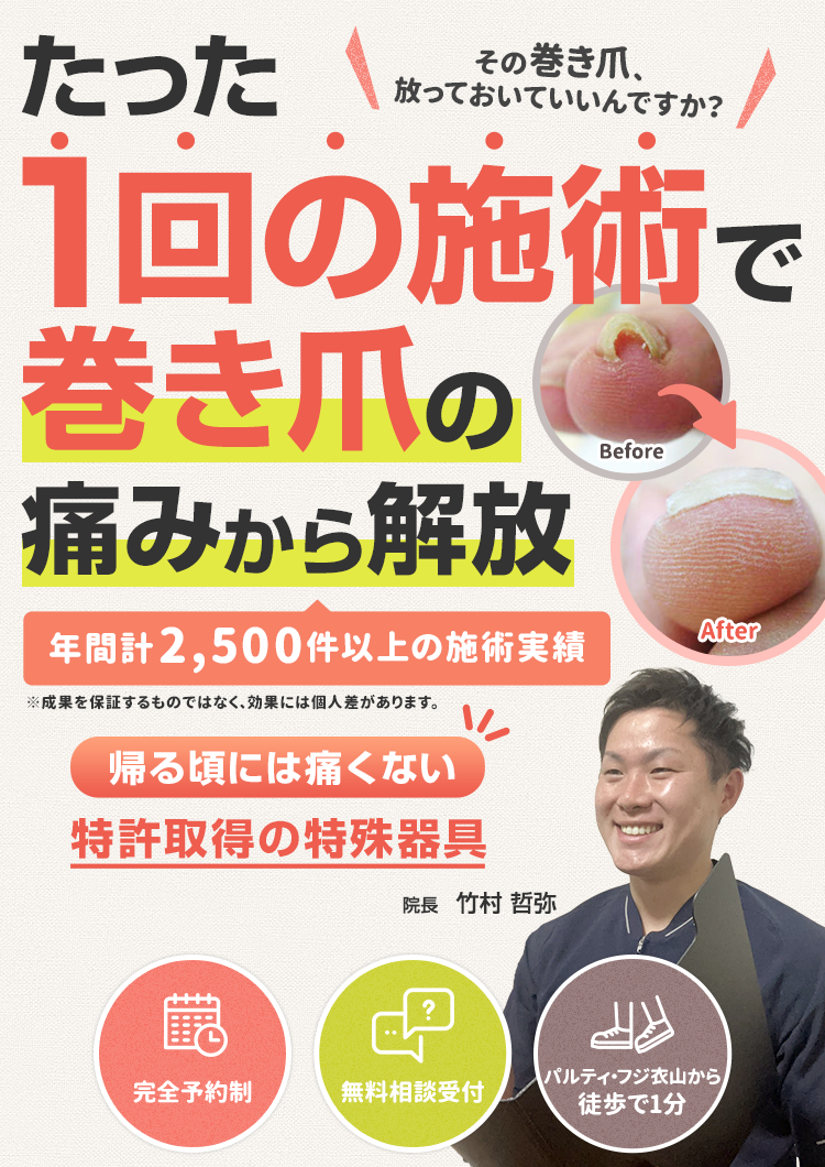 たった1回の施術で巻き爪の痛みから解放
